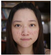 保定京都脸上为什么反反复复长痘痘