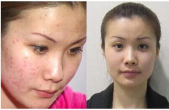 保定京都痘痘怎么治疗？