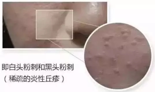 保定祛黑头痘痘医院