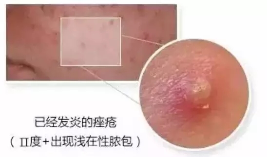 保定脓包型痘痘怎么治