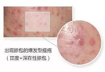 爆发型脓包痘痘怎么办