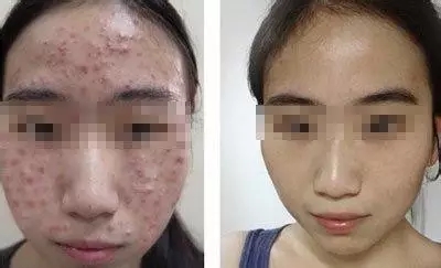 保定看痤疮/痘印/青春痘哪里好